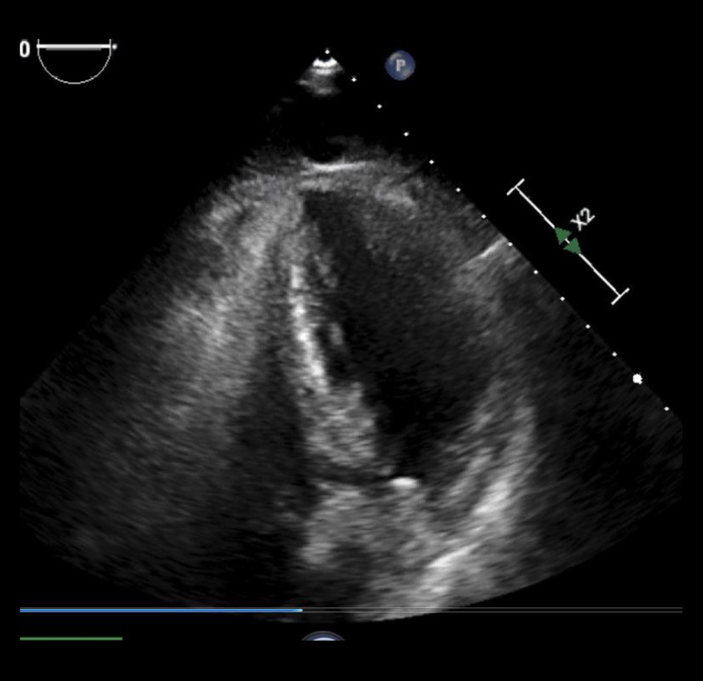 Echocardiography, left ventricle in systole; takotsubo image.