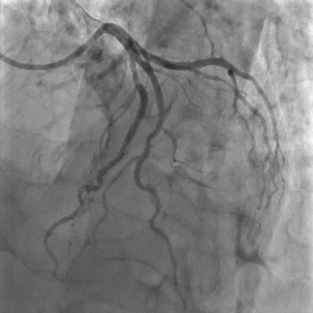 Left coronary artery exhibited by the coronary angiography (insignificant atherosclerosis).