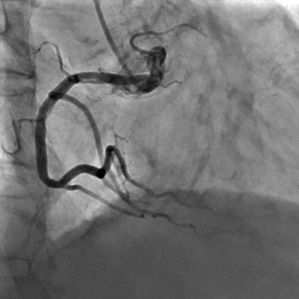 Right coronary artery exhibited by the coronary angiography (insignificant atherosclerosis).