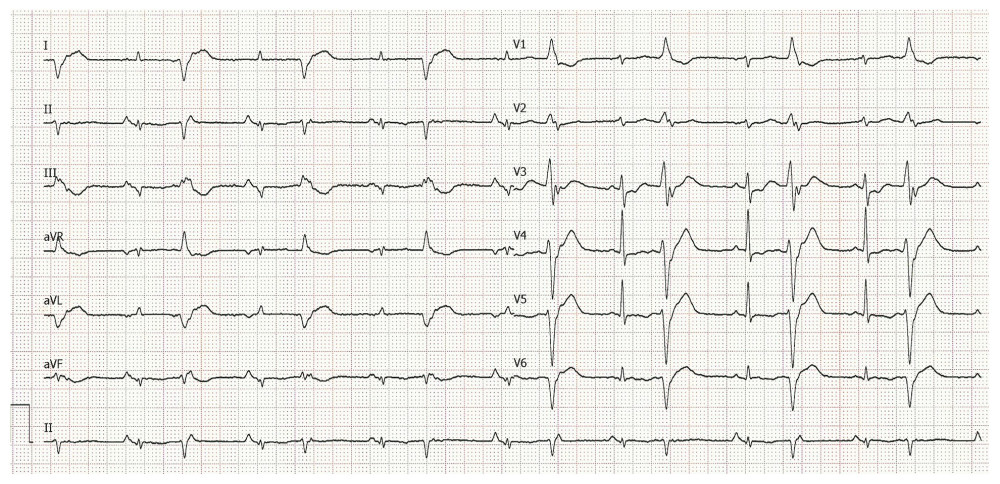 Electrocardiogram performed on the fourth day.