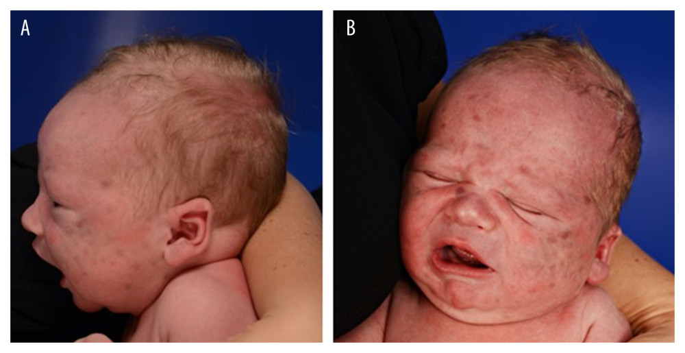 (A, B) Skin lesions on post-partum day 3, showing multiple purple-to-violaceous, nonblanchable macules several millimeters in size on the patient’s face, with only a few lesions being slightly elevated.