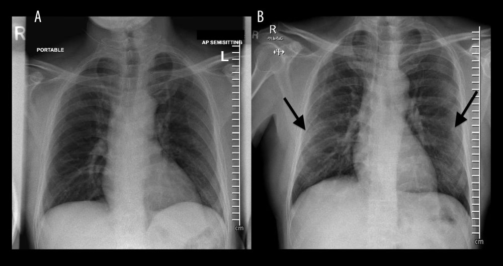 (A) Plain radiograph chest anteroposterior view at day 0. Chest X-ray at initial presentation with no significant abnormalities and no infiltration. (B) Plain radiograph chest anteroposterior view at day 86. Chest X-ray at 86 days with mild haziness in bilateral lower lung zones suggestive of infiltration (marked by black arrow). Infiltration is more notable in the peripheral area than the central area.