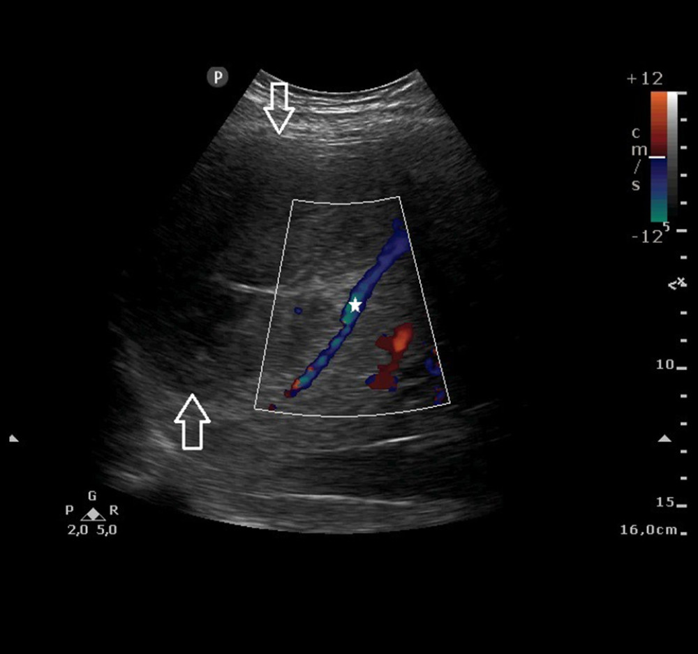 Abdominal ultrasound showing a mass in the right liver lobe with a heterogeneous structure and net borders (arrows), which is compressing surrounding structures such as the inferior vena cava (as revealed by the color Doppler signal filling its lumen) (white star).