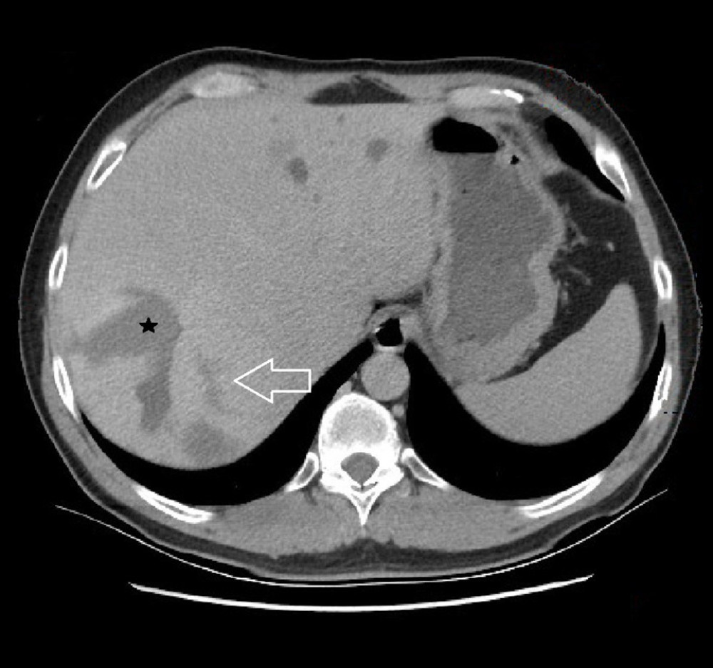 Axial sections from contrast-enhanced computed tomography showing a cavernous hemangioma with partial homogenization in the late phase (arrow) and a fibrotic area that is not opacified (black star).