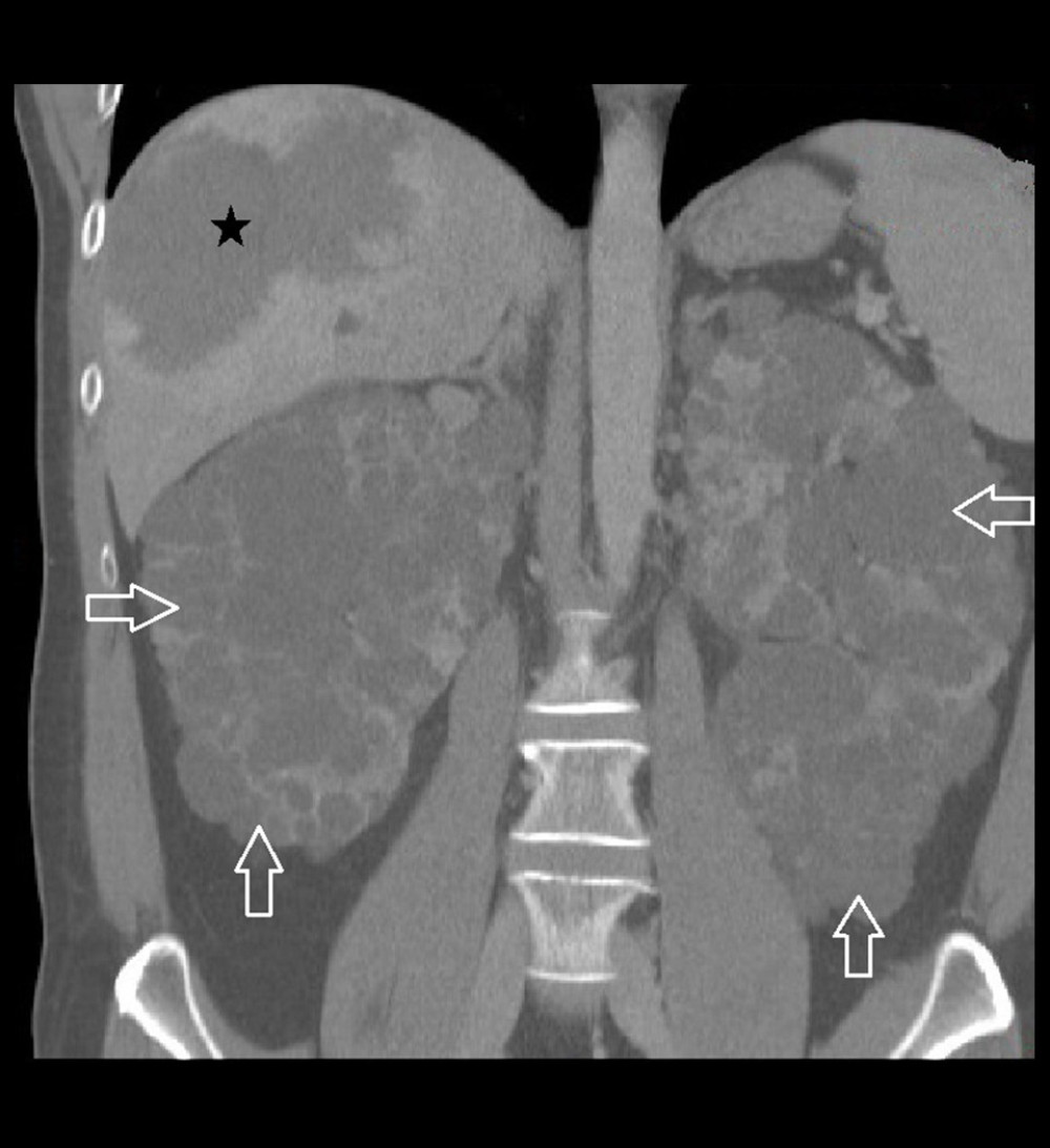 Reconstructed coronal contrast-enhanced computed tomography scan showing a giant cavernous liver hemangioma (black star) and numerous bilateral kidney cysts (arrows).