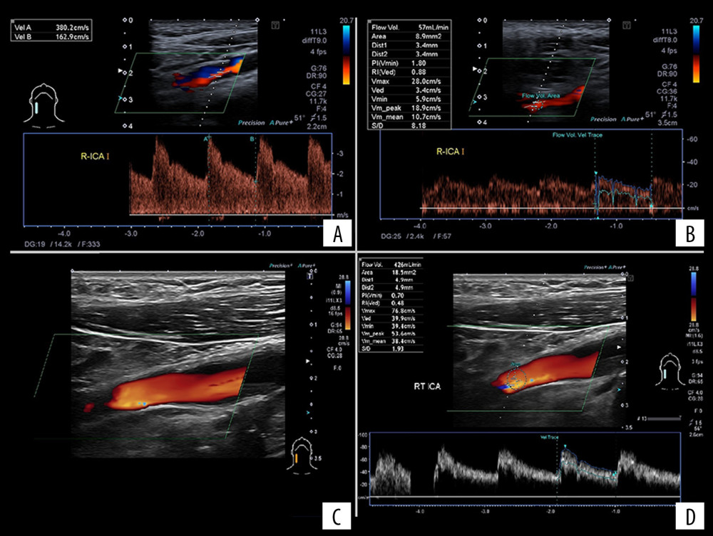Flow volume changes in the right internal carotid artery. (A) Significant 80% to 85% stenosis with flow velocities of 3.8/1.63 m/s. (B) Reduction of the flow in the upper part of right internal carotid artery (ICA) with flow volume of 57 mL/min. (C) Right ICA after endarterectomy. (D) Laminar flow with a volume of 426 mL/min 4 months after endarterectomy.
