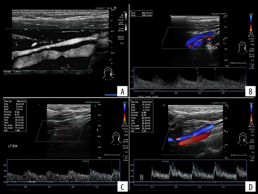 Flow volume changes in left internal carotid artery (ICA). (A) Recurrent left ICA stenosis due to neointimal hyperplasia. (B) Flow velocities in the left ICA of 2.62/1.09 m/s indicating 80% stenosis. (C) Flow reduction in the upper part of the left ICA with velocities of 0.42/0.2 m/s and a volume of 89 mL/min. (D) Flow normalization after successful stent implantation, with an increase of flow velocity to 243 mL/min 4 months after angioplasty.