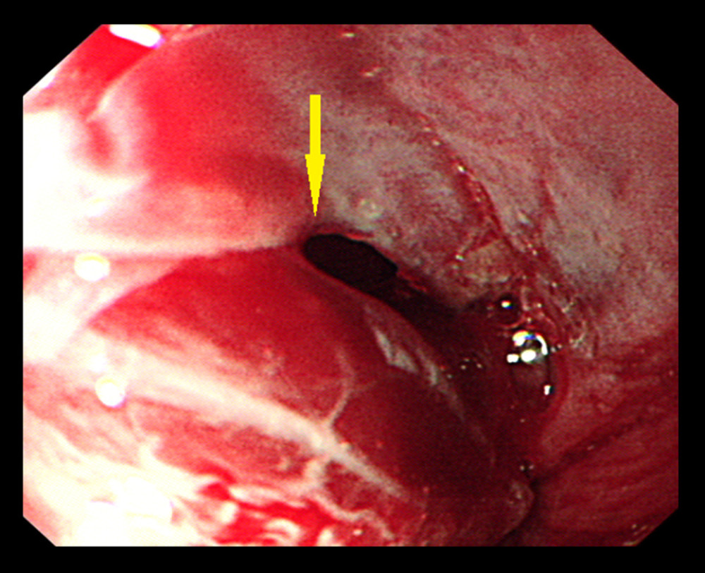 Endoscopic view showing the esophageal tear.