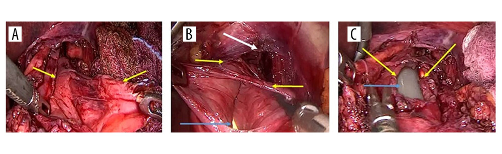 Laparoscopic view showing the esophageal tear. (A) The esophageal muscular layers completely teared, held by 2 graspers (yellow arrows). (B) The injured esophageal mucosa, the yellow arrows showing multiple tears, the blue arrow showing the tube inside. (C) The oro-gastric calibration (blue arrow) tube passing through the esophagus to the stomach.