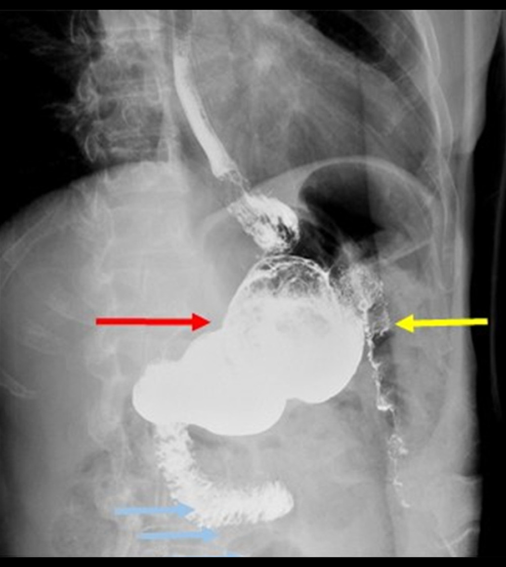Postoperative oral contrast study showing passage of the oral contrast through 2 tracts: to the stomach (red arrow) and to the jejunum (yellow arrow).