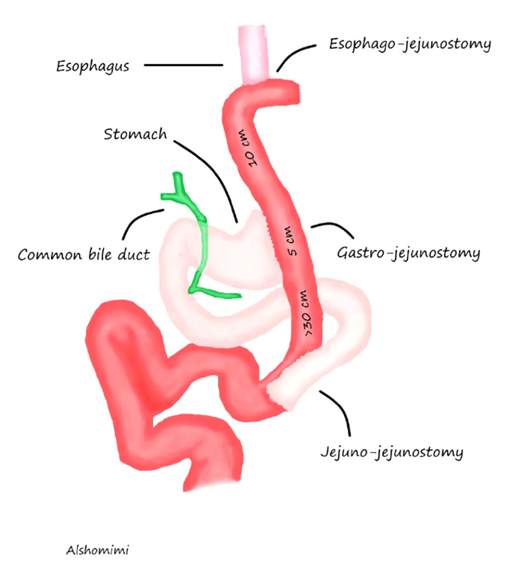 Diagram of double-tract esophago-jejunostomy showing the 3 anastomoses: end-to-end esophagojejunostomy, end-to-side jejuno-jejunostomy, and side-to-side gastro-jejunostomy.