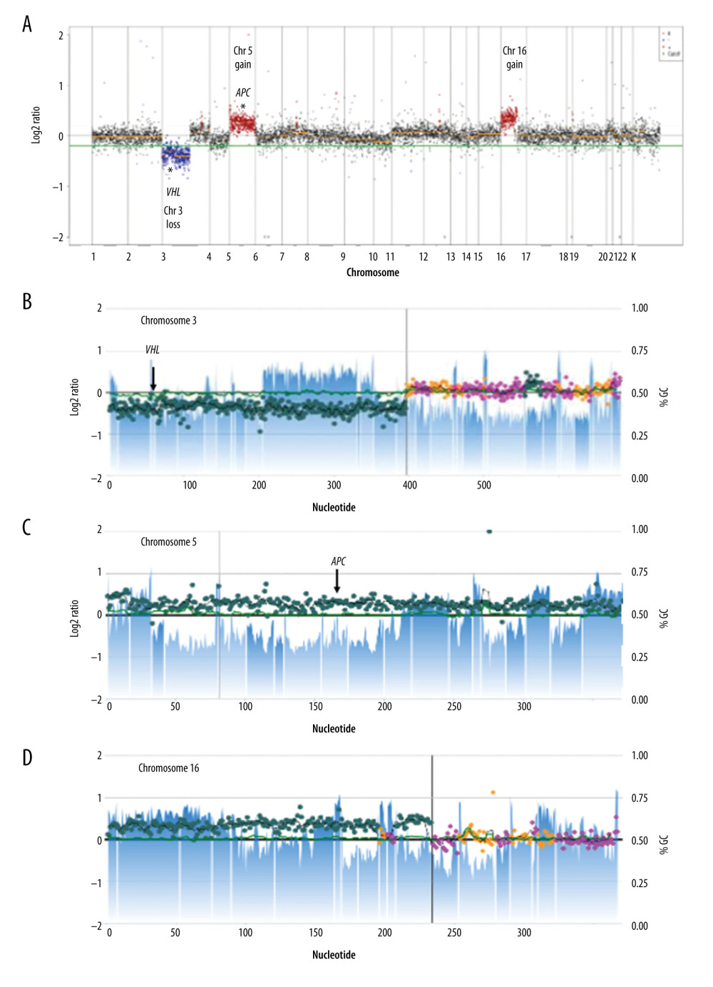 The somatic OncoPanel (BWH Pathology, Boston, MA, USA.) profile obtained from the retroperitoneal lymph node biopsy showed multiple copy number changes consistent with the patient’s RCC. (A) An all chromosome view of the sample copy number plot. Each contiguously baited segment is represented by a dot, the read counts were normalized against a panel of normal samples and the log2 ratios were plotted. (B) One single-copy loss in 3p encompassing 3p25.3 where the VHL gene resides on the chromosome. (C) Single-copy gain along chromosome 5 encompassing 5q22.2 where the APC gene resides on the chromosome. (D) Single-copy gain of a part of 16p. Axis labels and descriptions: Nucleotide position of baited regions (×1000) (X-axis); log2 ratio (Y-axis, left). % GC, graphical representation of the GC content of each segment in blue (Y-axis, right). The vertical line in each panel delineates the position of the centromere in each chromosome. Copy number calls were made using an adaptive calling method that adjusts the threshold per sample. For 3p, chromosome 5, and 16p, the average log2 ratios were −0.38, 0.26, and 0.34, respectively. Gains and losses were called respectively, using thresholds of 0.25 and −0.32.