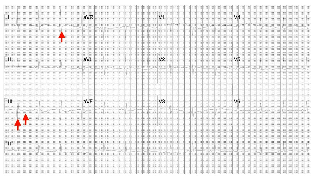 Arrows showing a S1Q3T3 pattern on 12-lead electrocardiogram.