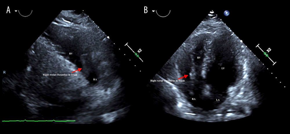 Transthoracic echocardiogram showing right atrial thrombus-in-transit in parasternal right ventricular inflow (A) and apical 4-chamber (B) views. LA – left atrium; LV – left ventricle; RA – right atrium; RV – right ventricle.