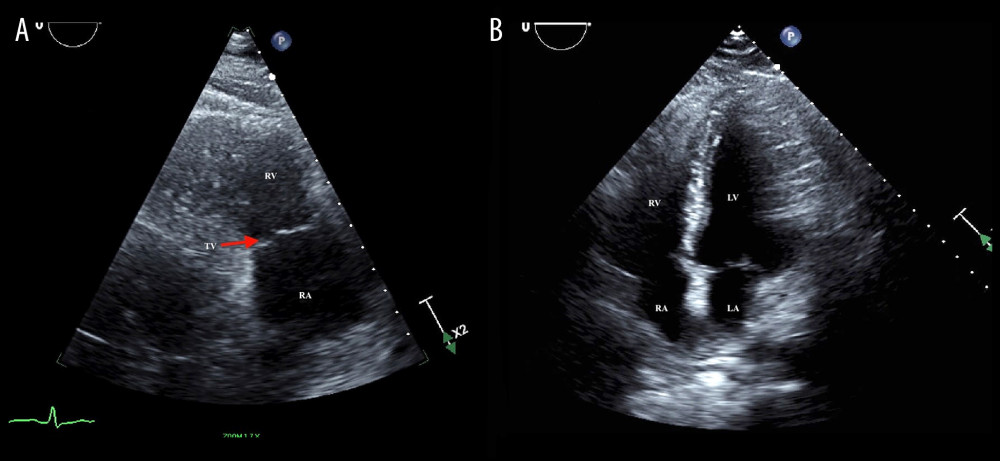 Transthoracic echocardiogram showing complete dissolution of thrombus in parasternal right ventricular inflow (A) and apical 4-chamber (B) views. TV – tricuspid valve; LA – left atrium; LV – left ventricle; RA – right atrium; RV – right ventricle.