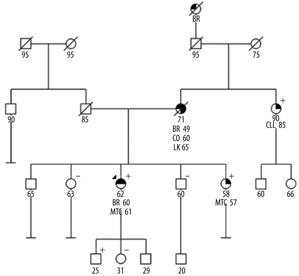 Pedigree of a family with RET p.V804M variant. The pedigree depicts individuals with cancer, cancer types, and RET p.V804M genotype when available. Positive and negative signs denote presence and absence of RET p.V804M, respectively. Circles and squares denote female and male family members, respectively. Arrow indicates proband. Numbers under circles or squares reflect current age or age at death if deceased, and numbers beside diagnosis reflect age at diagnosis. Filled quadrants denote affected conditions. BR – breast cancer; CO – colon cancer; MTC – medullary thyroid cancer; CLL – chronic lymphoid leukemia.
