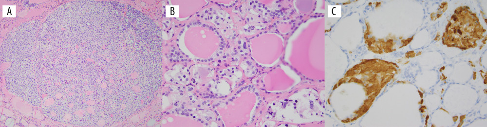 Histologic findings in the thyroidectomy specimen. (A) An example of a medullary microcarcinoma (H&E stain) at ×100 magnification. (B) C-cell hyperplasia (H&E stain) at ×400 magnification. (C) Calcitonin stain highlights the C cells at ×400 magnification. H&E, hematoxylin and eosin.