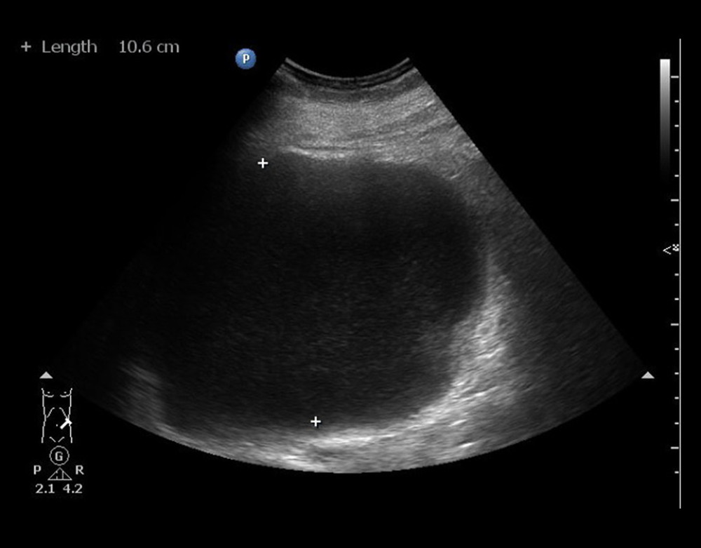 Left renal ultrasound image from a 29-year-old woman with congenital left duplex kidney with hydronephrosis that presented as a left renal cyst. The ultrasound image shows a large fluid-filled space measuring 10×16 cm in diameter that was initially diagnosed as a renal cyst or as a renal abscess.