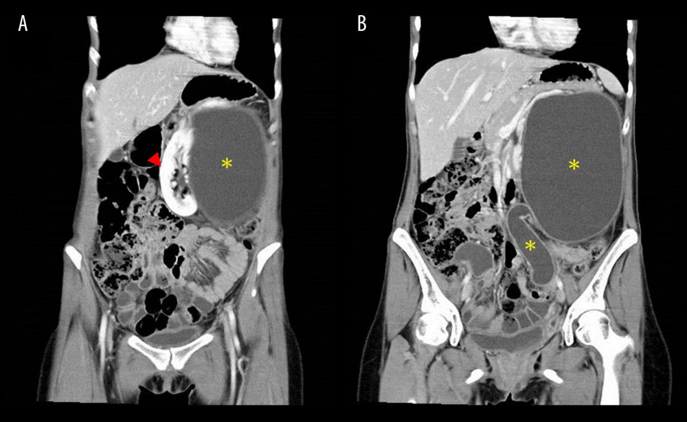 Coronal view of abdominal CT images from a 29-year-old woman with congenital left duplex kidney with hydronephrosis that presented as a left renal cyst. (A) The left kidney is compressed by a fluid-filled cyst measuring 10×16 cm in diameter (arrow head). (B) The left cyst with dilated ureter extended to the pelvis, which made us suspect a duplex kidney with hydronephrosis and hydroureter (asterisk).