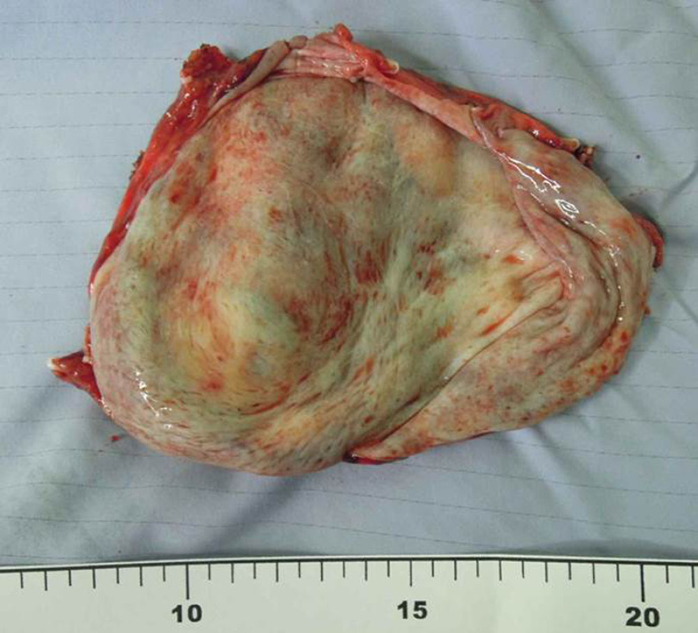 The surgical specimen following robot-assisted heminephrectomy from a 29-year-old woman with congenital left duplex kidney with hydronephrosis. The excised cystic structure measures×cm in diameter and has a pale fibrotic wall. There is no evidence of tumor or abscess.
