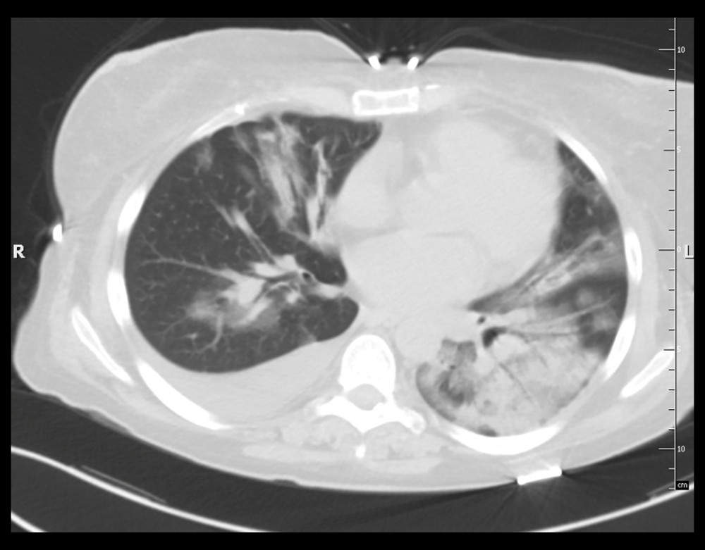 Case 1: Computed tomography (CT scan) of the chest without contrast (lung window). Extensive areas of ground-glass opacity and areas of consolidation are visible on both sides, with inflammatory lesions in the left lung and fluid in the right pleural cavity.