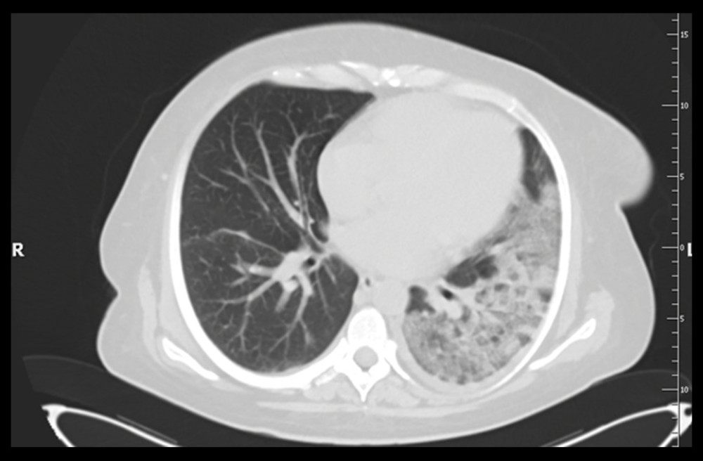 Case 2: Computed tomography (CT scan) of the chest without contrast (lung window). The left lung shows massive areas of the crazy-paving pattern resulting from the superimposition of a thickened interlingual partition on the ground-glass opacity lesions and discreet changes in the right lung.