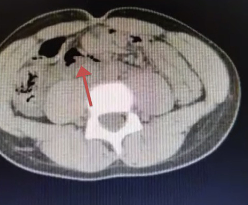 Computed tomography (CT) abdomen axial view. CT abdomen axial view showing retropneumoperitoneum around duodenal topography (red arrow).