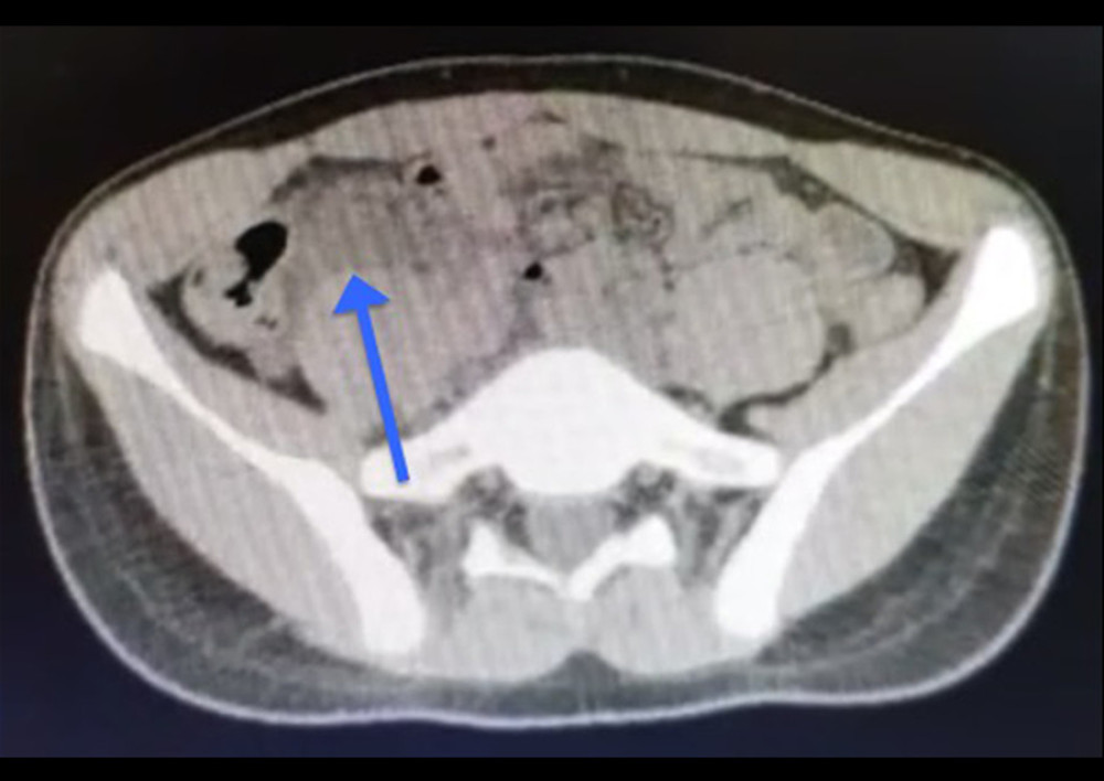 Computed tomography (CT) abdomen axial view. CT abdomen axial view showing free fluid in the abdominal cavity (blue arrow).