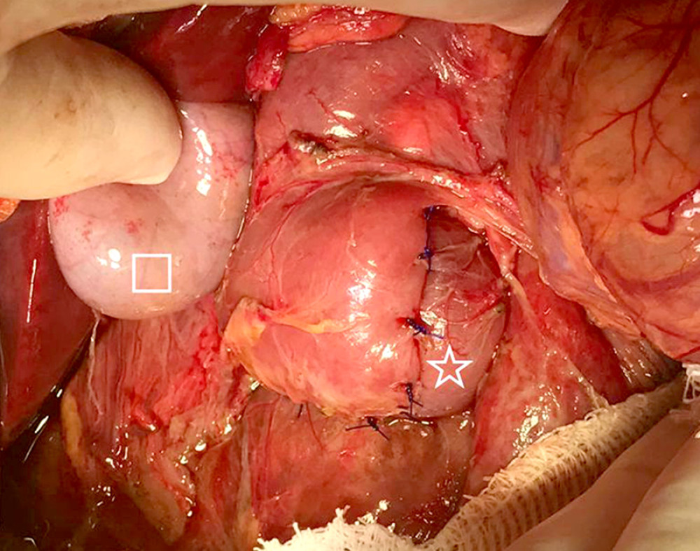 Duodenal double-layer closure with monofilament 3-0 polypropylene suture. Square, gallbladder; star, duodenal closure.
