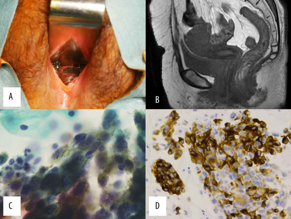 Preoperative examinations: (A) Internal examination showed a 20×20 mm black and flat lesion on the posterior vaginal wall. (B) T2-weighted magnetic resonance imaging revealed no vaginal or uterus cervix mass. (C) Pap ×100. Vaginal cytology showed atypical cells with nuclear pleomorphisms and melanin production. (D) Immunohistochemical staining of vaginal cytology cell blocks showed the tumor cells were positive for melan-A.