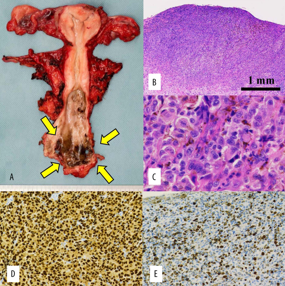 Postoperative examinations: (A) Macroscopically, a tumor of size 45×25 mm with a black surface was detected in the posterior vaginal wall (yellow arrows). (B) Hematoxylin and eosin ×4; and (C) Hematoxylin and eosin ×40. Microscopically, the tumor cells were arranged in sheets and nests and exhibited nuclear pleomorphism, an eosinophilic cytoplasm, brisk mitotic activity, and melanin production. Immunohistochemically, the tumor was positive for (D) SOX10 and (E) the Ki-67 labeling index was 70%.