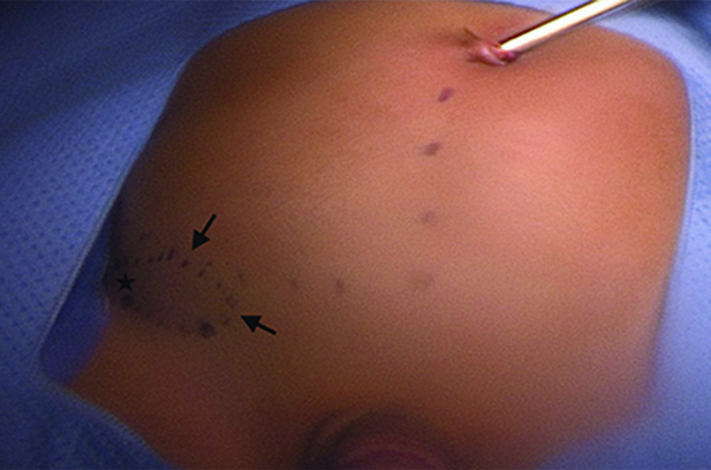 An external view of the abdominal wall hernia during laparoscopy. The arrows indicate the edges of the defect. A star marks the site corresponding to the testis.