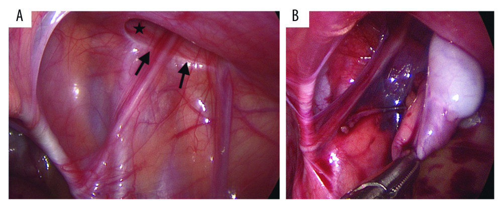 A laparoscopic view of the abdominal wall defect. A star marks the pathway to the right internal ring (closed and no patent processus vaginalis). (A) Arrows mark both the vas deferens and the testicular vessel entering the defect, which is located superior to the inguinal ligament. (B) The right ectopic testis herniating into the defect.