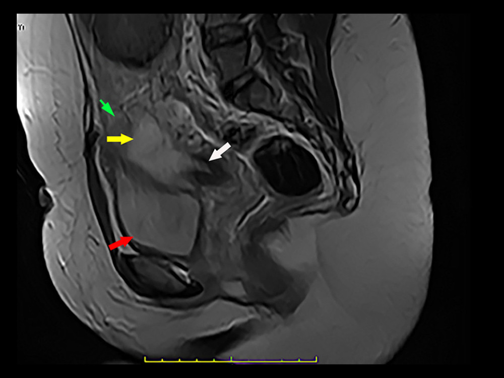 Sagittal T2 weighted magnetic resonance image through the pelvis. The posterior aspect of the gestational sac (yellow arrow) extends into the endometrial cavity of the lower uterine segment (white arrow). Urinary bladder (UB) (red arrow); upper uterine segment (green arrow).