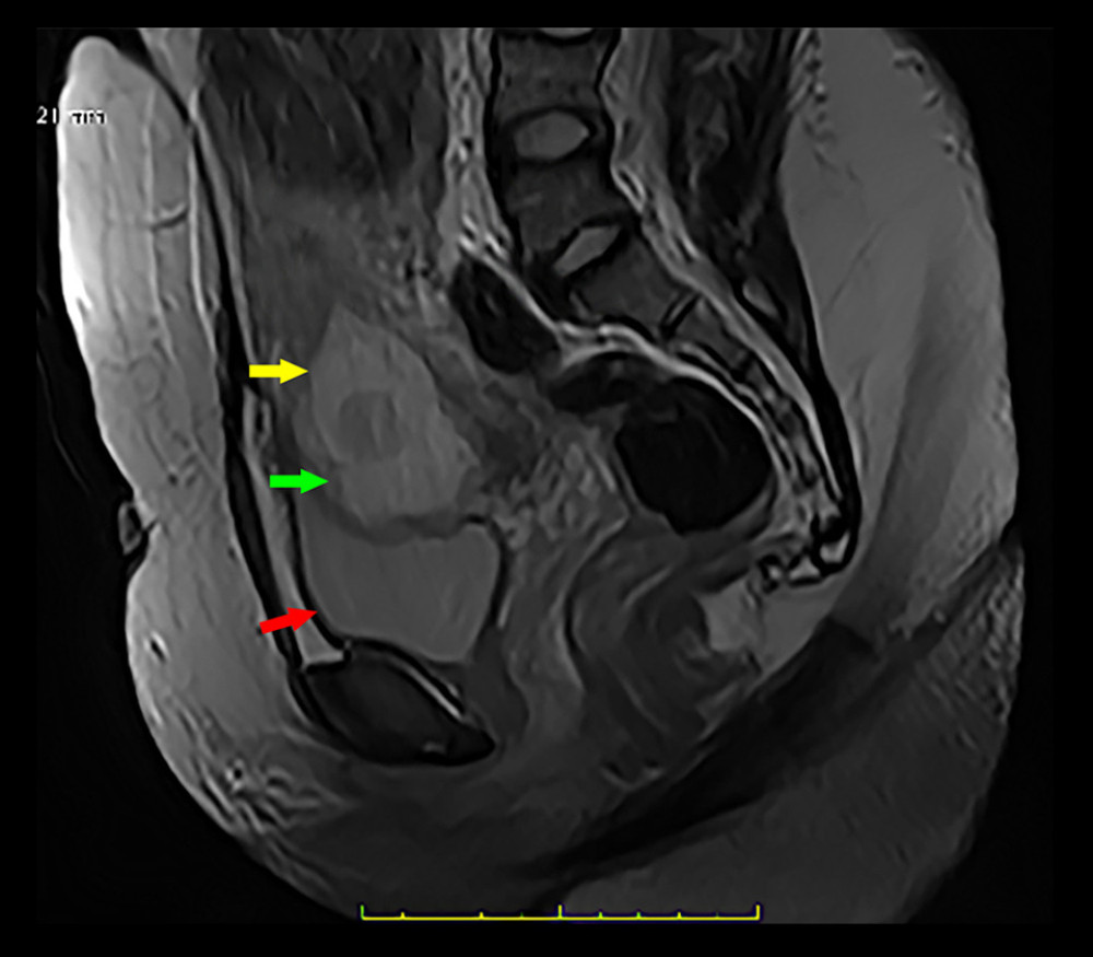 Midline sagittal T2 weighted magnetic resonance image through the pelvis. Gestational sac (yellow arrow) within the myometrium of the lower uterine segment. Anterior to the gestational sac, the myometrium is thinned (green arrow). Normal urinary bladder (UB) (red arrow).