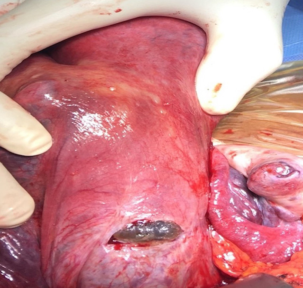 Laparotomy via Pfannenstiel incision with products of conception exposed in the prior cesarean section scar. The urinary bladder is not involved.