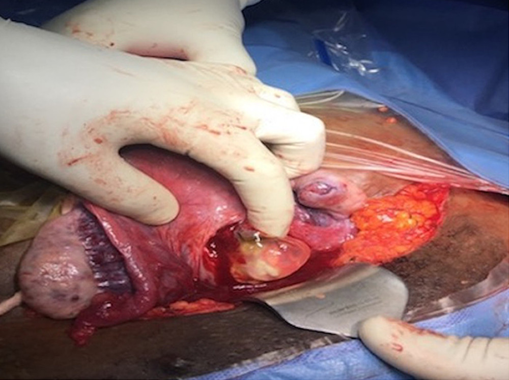 Laparotomy via Pfannenstiel incision with products of conception exposed in the prior cesarean section scar. The urinary bladder is not involved.