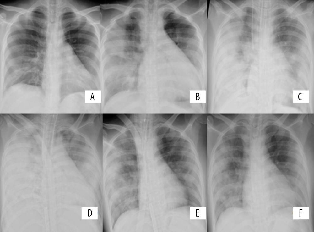 Anteroposterior chest X-ray in a 30-year-old woman who underwent cesarean section at 36 weeks of pregnancy with COVID-19 infection showing the lung changes after the onset of symptoms and hospital admission. (A) Day 6 after the onset of symptoms, the lung fields show faint bilateral patchy opacities. (B) Day 8 after the onset of symptoms, radiological worsening, with involvement of lower lobes. (C) Hospital day 1 (day 9 after the onset of symptoms), the lung fields show bilateral alveolar consolidation with panlobular affectation, with typical radiological findings of ARDS. Endotracheal tube and central venous line were required. (D) Hospital day 7, the lung fields show radiological worsening. extracorporeal membrane oxygenation (ECMO) was administered. (E) Hospital day 15, the lung fields show radiological improvement after ECMO therapy. (F) Hospital day 19 after extubation, the lung fields show radiological improvement.