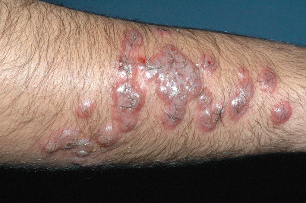 Multiple large, erythematous, fluid-filled, dome-shaped to round painless nodules across the right forearm of the patient. Some of them had coalesced, forming large plaques, and a few nodules had watery or yellowish discharge.