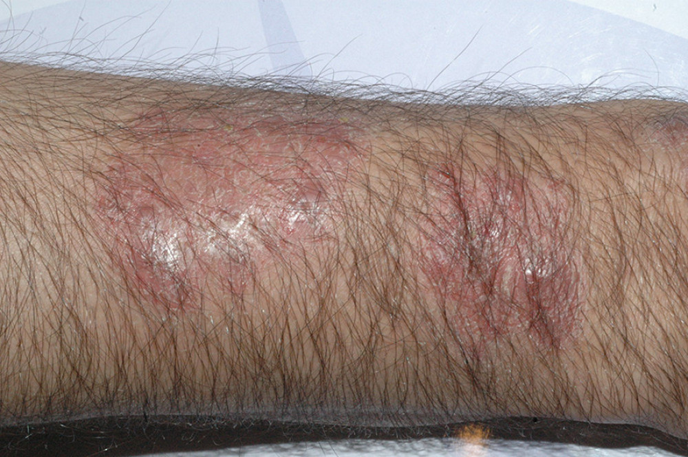 The patient was given 2% fusidic acid cream. After several weeks, all the nodules disappeared spontaneously, leaving some post-inflammatory hyper-pigmentation.