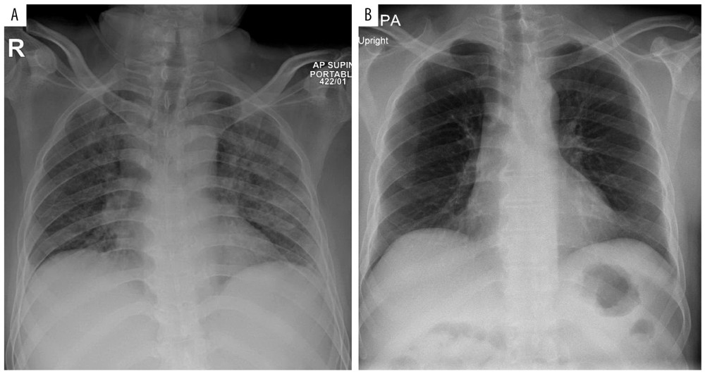 Chest X-ray (CXR) (A. Initial CXR showing bilateral pulmonary opacities, B. Follow-up CXR showing post-treatment resolution of opacities).