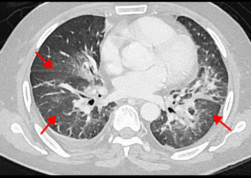 Computed tomography (CT) scan Thorax (Red arrows: Patchy consolidation and air bronchograms consistent with ARDS).