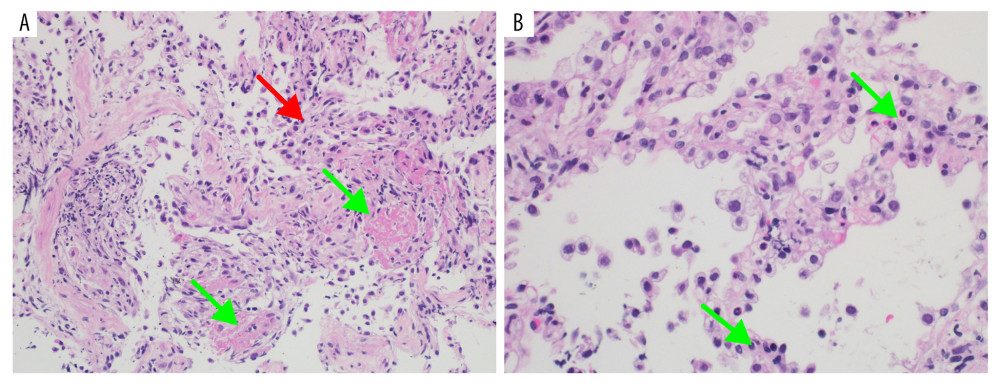 Photomicrographs of the histology of the lung biopsies (day 5 of admission) in a 43-year-old man with a history of tuberculous meningitis and rifampicin pneumonitis who presented with symptoms that mimicked severe COVID-19 pneumonia with negative test results for SARS-CoV-2 infection. (A) Histology of the lung shows thickening of the alveolar walls (Red arrow) with an increase in mononuclear cells and pink hyaline membranes (Green arrows), consistent with diffuse alveolar damage (DAD) and with acute respiratory distress syndrome (ARDS) and also with rifampicin-induced pneumonitis. Hematoxylin and eosin (H&E) ×200. (B) Histology of the lung shows some residual thickening of the alveolar walls and type II pneumocyte hyperplasia without hyaline membranes. H&E ×400.