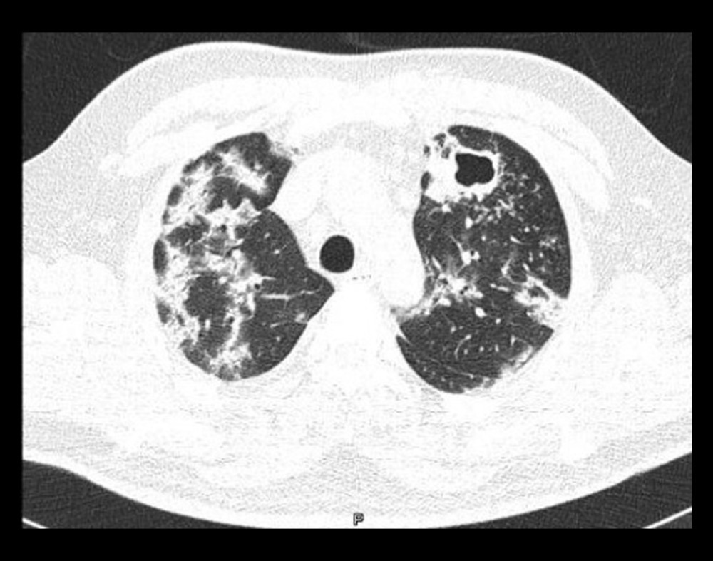 Chest computed tomography scan with lung window. The low attenuation in the left upper lobe and walls >4 mm surrounded by multiple centrilobular micronodules are consistent with a cavitation. In the rest of the parenchyma, subpleural and peri-bronchovascular pulmonary consolidations are visible. The patient was coinfected with COVID-19 and tuberculosis.