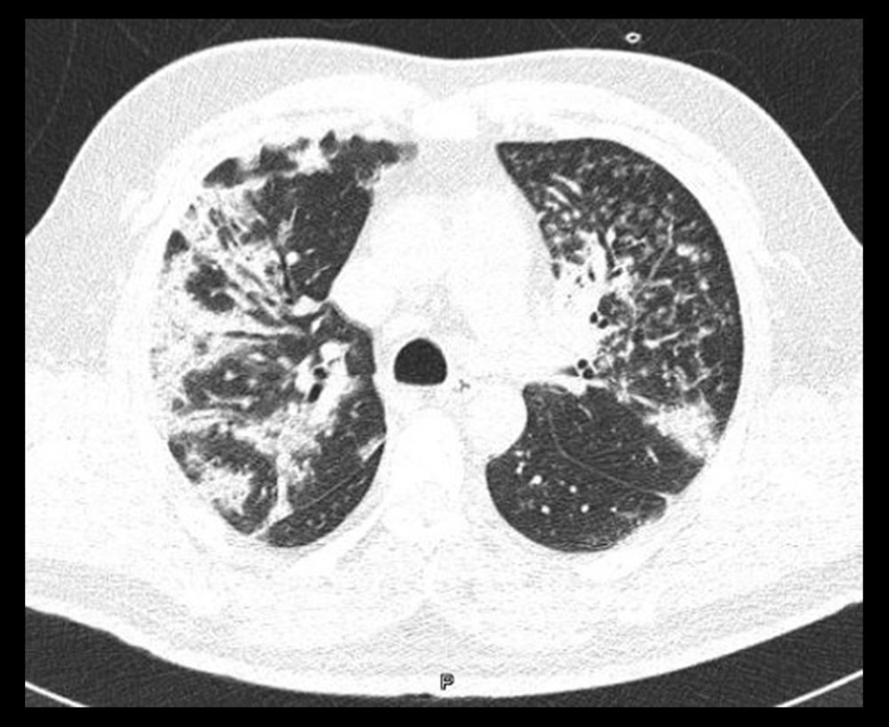 Chest computed tomography scan with lung window. The high attenuation in the images is consistent with centrilobular nodules and micronodules, as is the tree-in-bud pattern in the left upper lobe.
