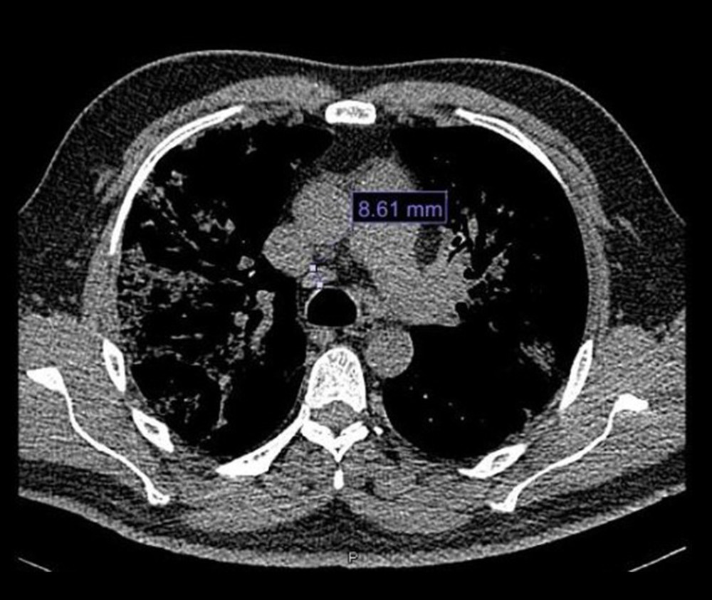 Chest computed tomography scan with mediastinal window. Mediastinal nodes measuring 8.61 mm are seen in the image of station 4R.