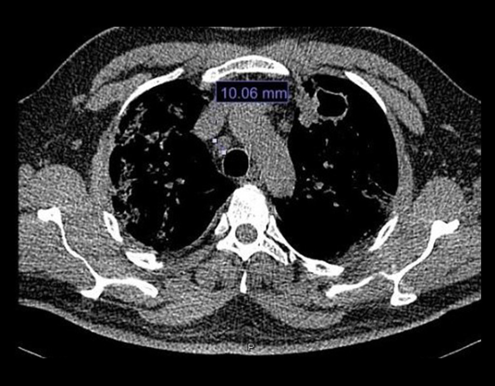 Chest computed tomography scan with mediastinal window, which shows 10.6-mm mediastinal nodes in the image of station 2R.