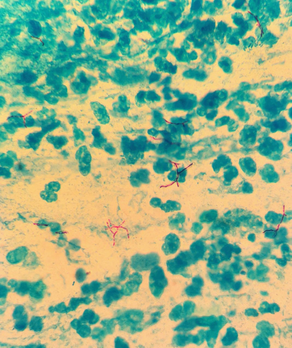 High-power photomicrograph taken with light microscopy which shows Ziehl-Neelsen staining (purple) of Mycobacterium tuberculosis in a sputum sample from a 51-year-old taxi driver from Mexico City. Magnification ×400.