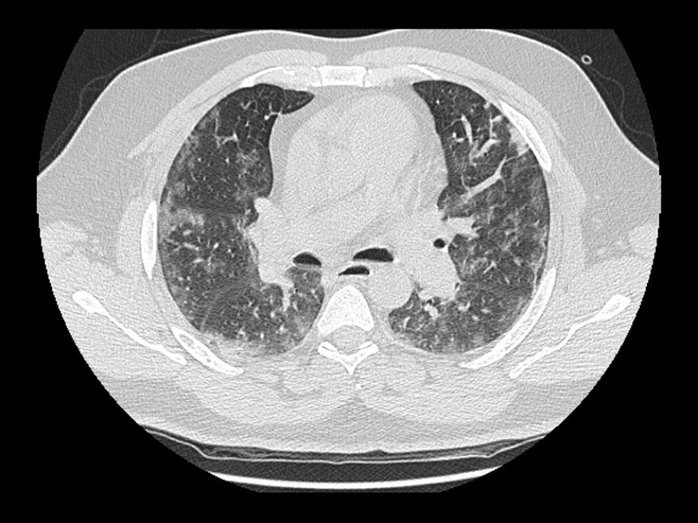 High-resolution computed tomography scan of the chest showing bilateral ground-glass opacities associated with severe COVID-19 pneumonia.
