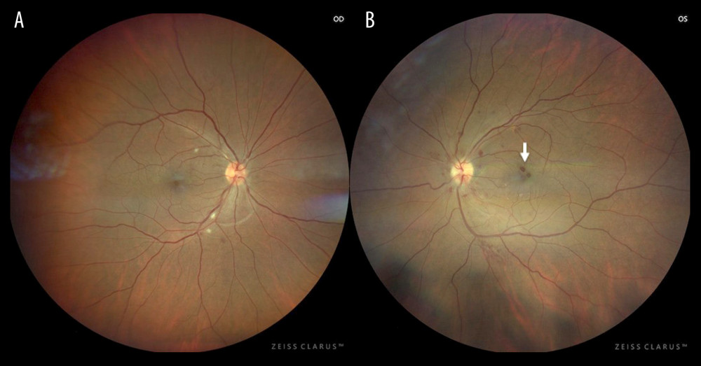 Fundal images. (A) In the right eye, there are multiple cotton wool spots surround the peripapillary area and minimal intraretinal hemorrhages in the inferior arcade. (B) In the left eye, there are multiple intraretinal hemorrhages affecting the peripapillary area and macula and a minimal increase in tortuosity of the vessels.